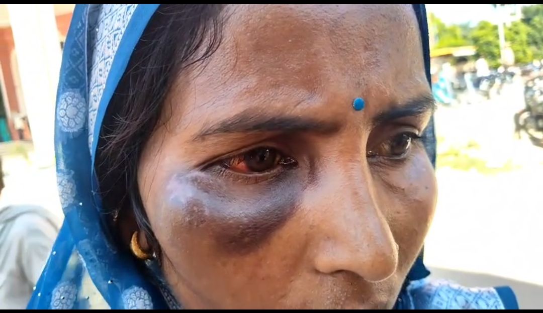 कुशीनगर: मामूली विवाद से भड़क गया खूनी हमला, महिला की आंख पर गंभीर चोट